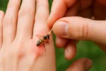 ¿Qué hacer si te pica una abeja o avispa?